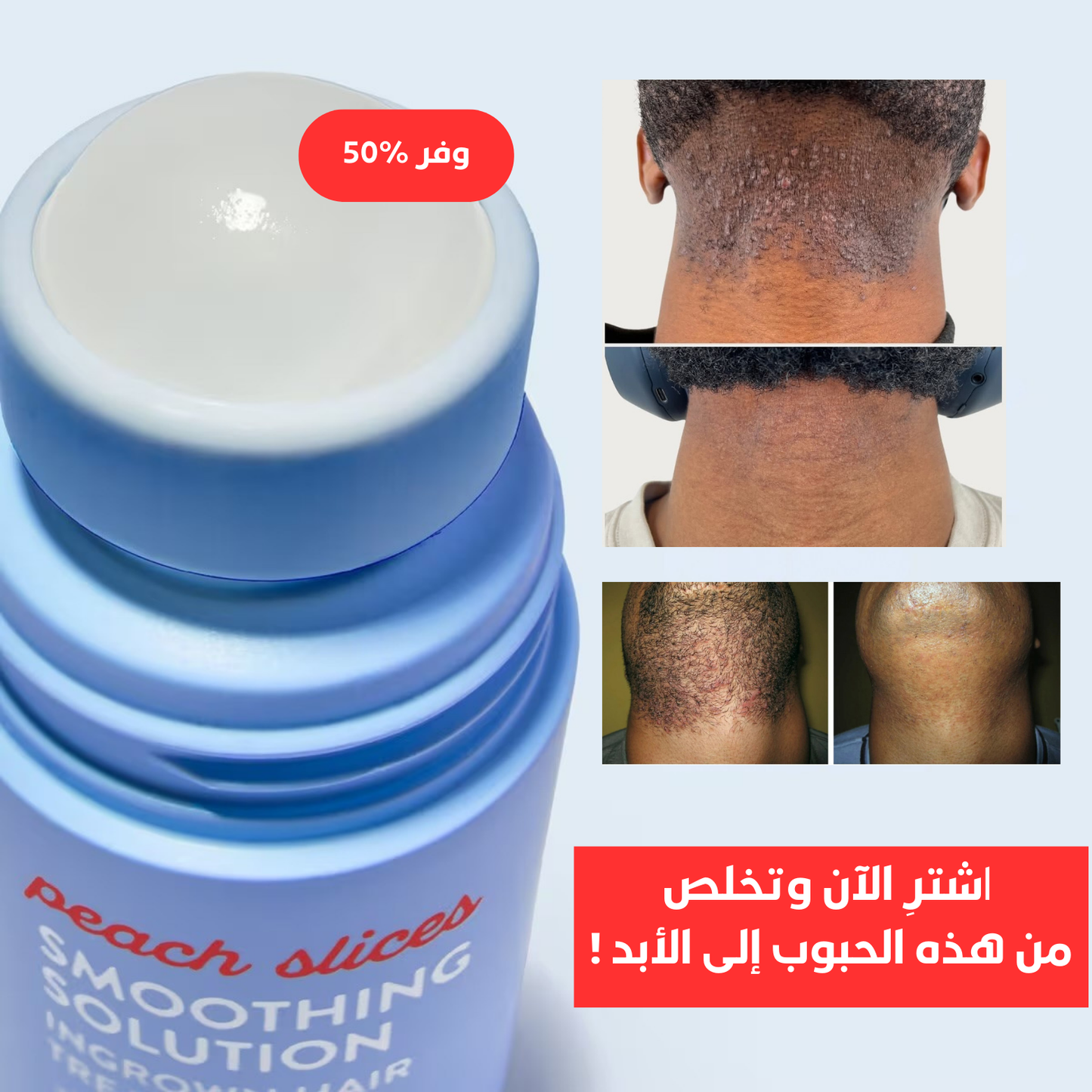 علاج التهيّج والشعر النامي تحت الجلد بعد الحلاقة