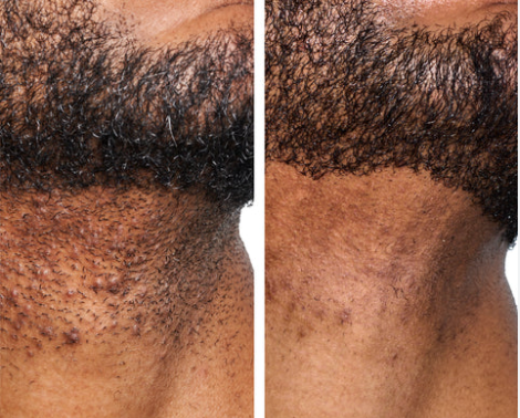 Smoothing solution™